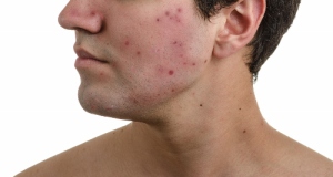 Acne, scars and keloids in the face of a man.