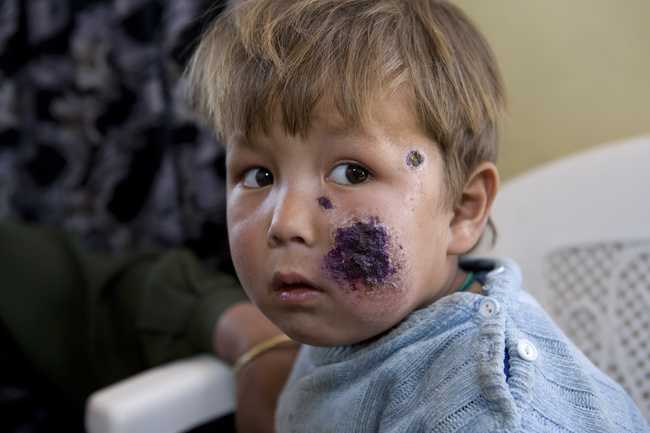 Paziente pediatrico con leishmaniosi cutanea a Kabul-Afghanistan.